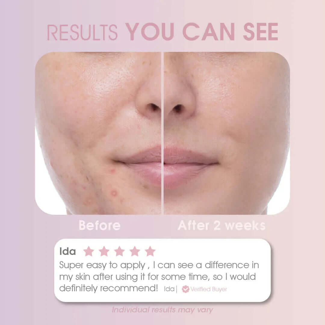 Acne Miracle